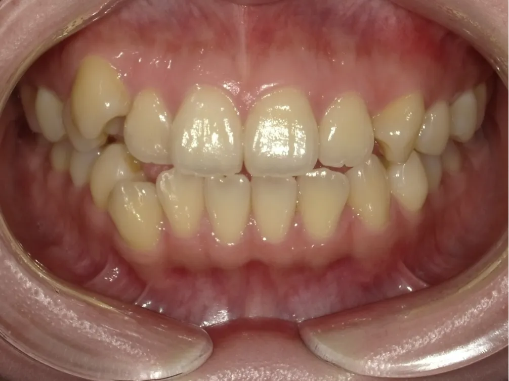 CASE15