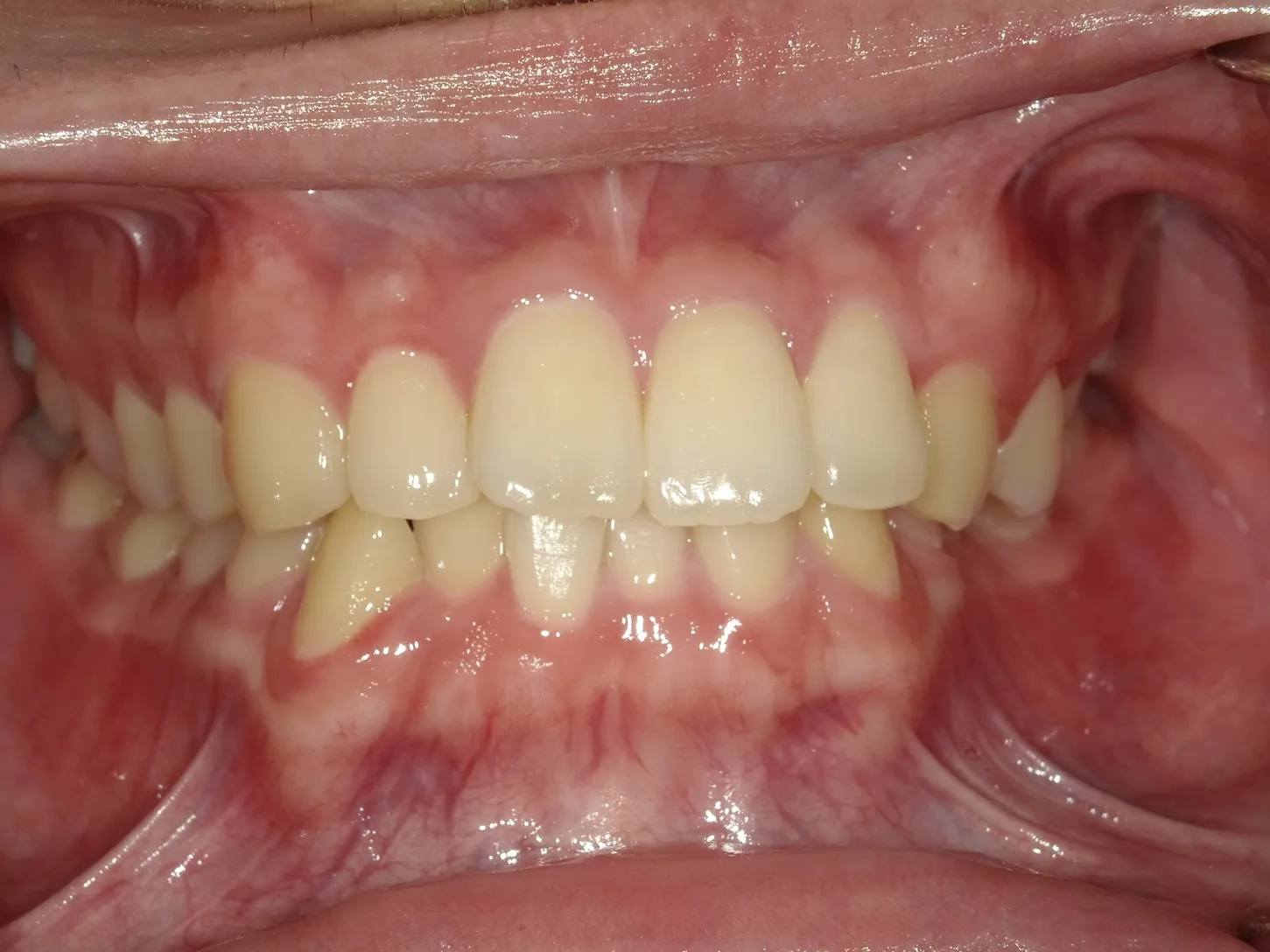 CASE18