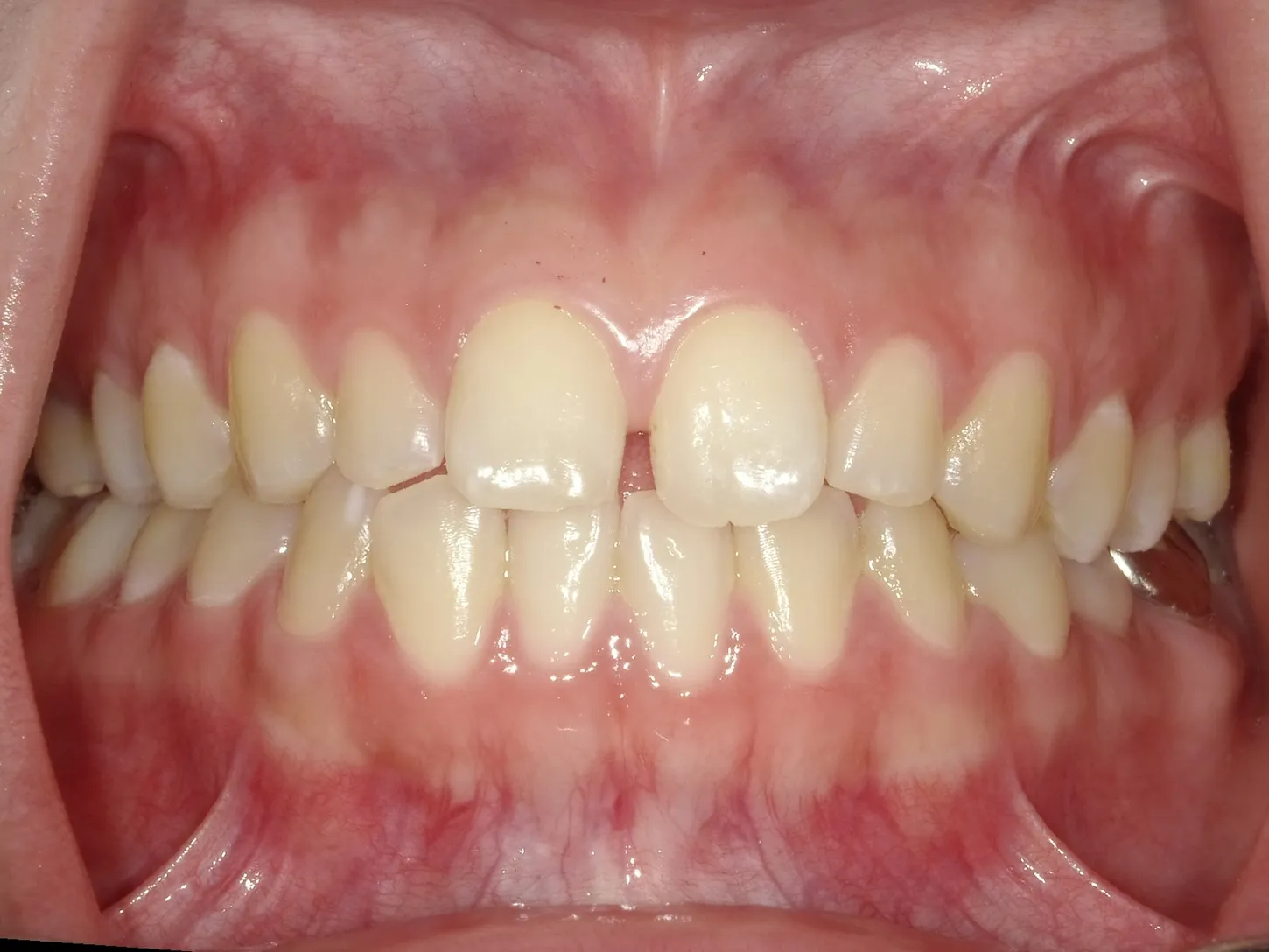 CASE12
