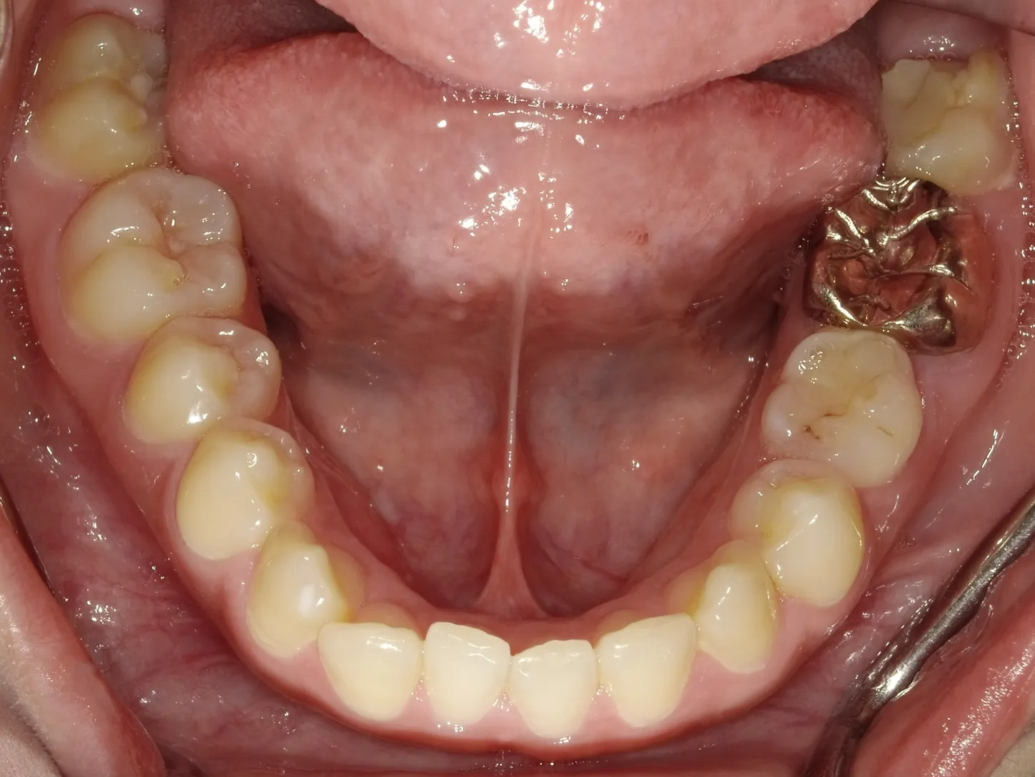 CASE12
