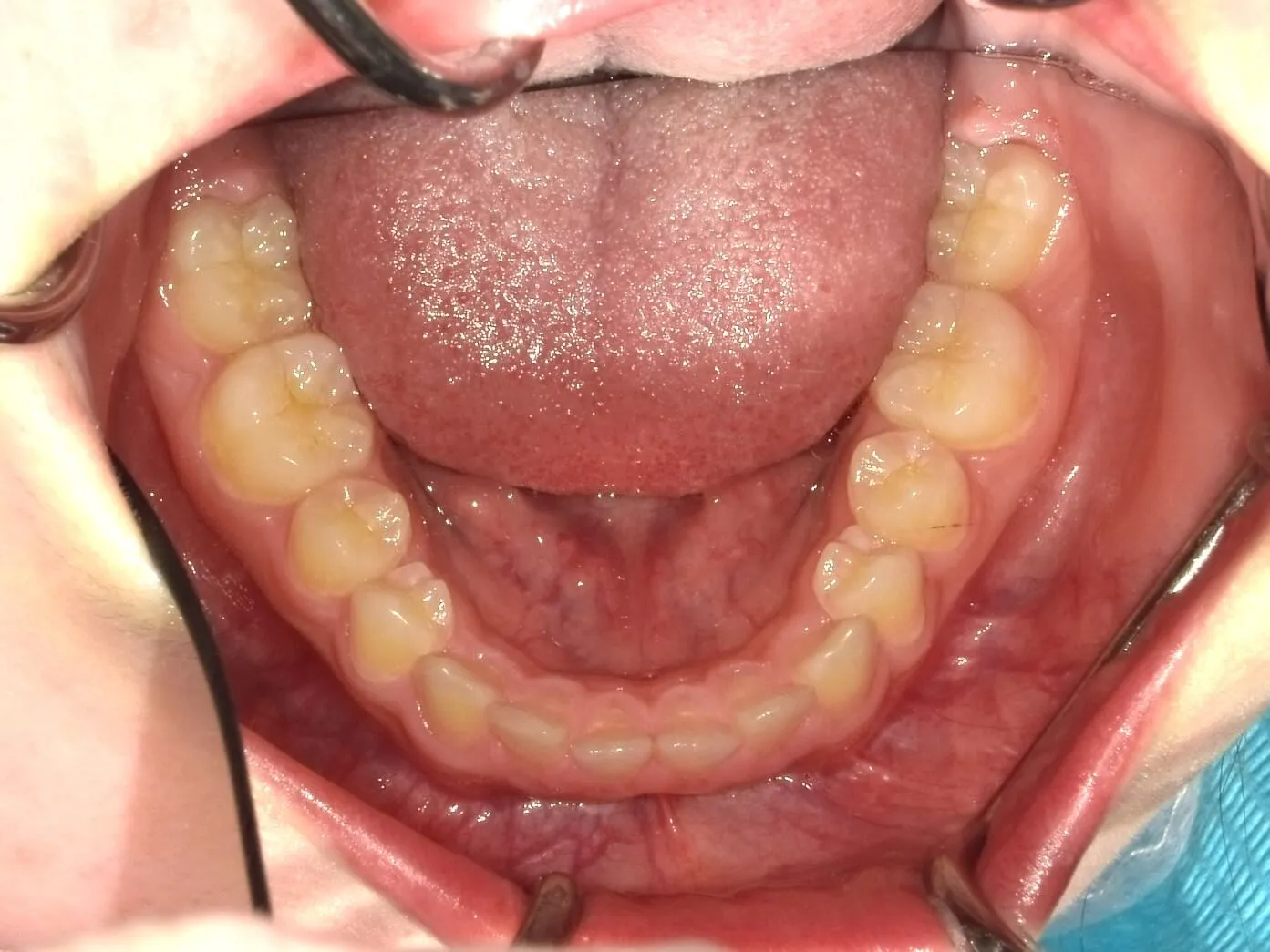 CASE04