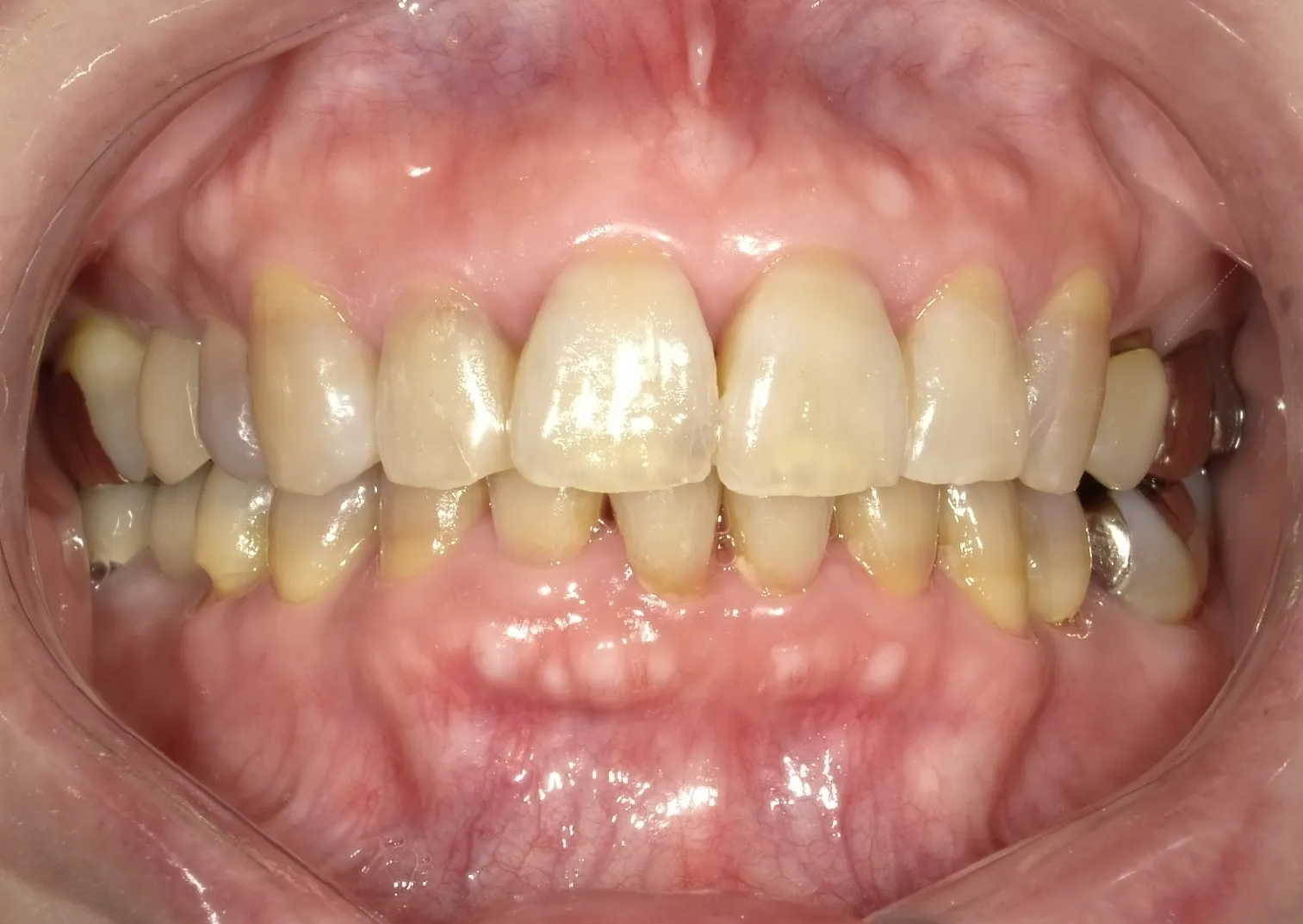 CASE15