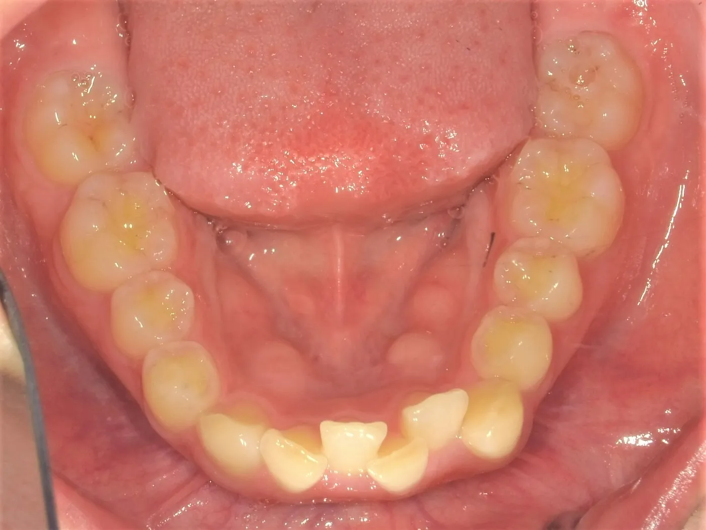 CASE21