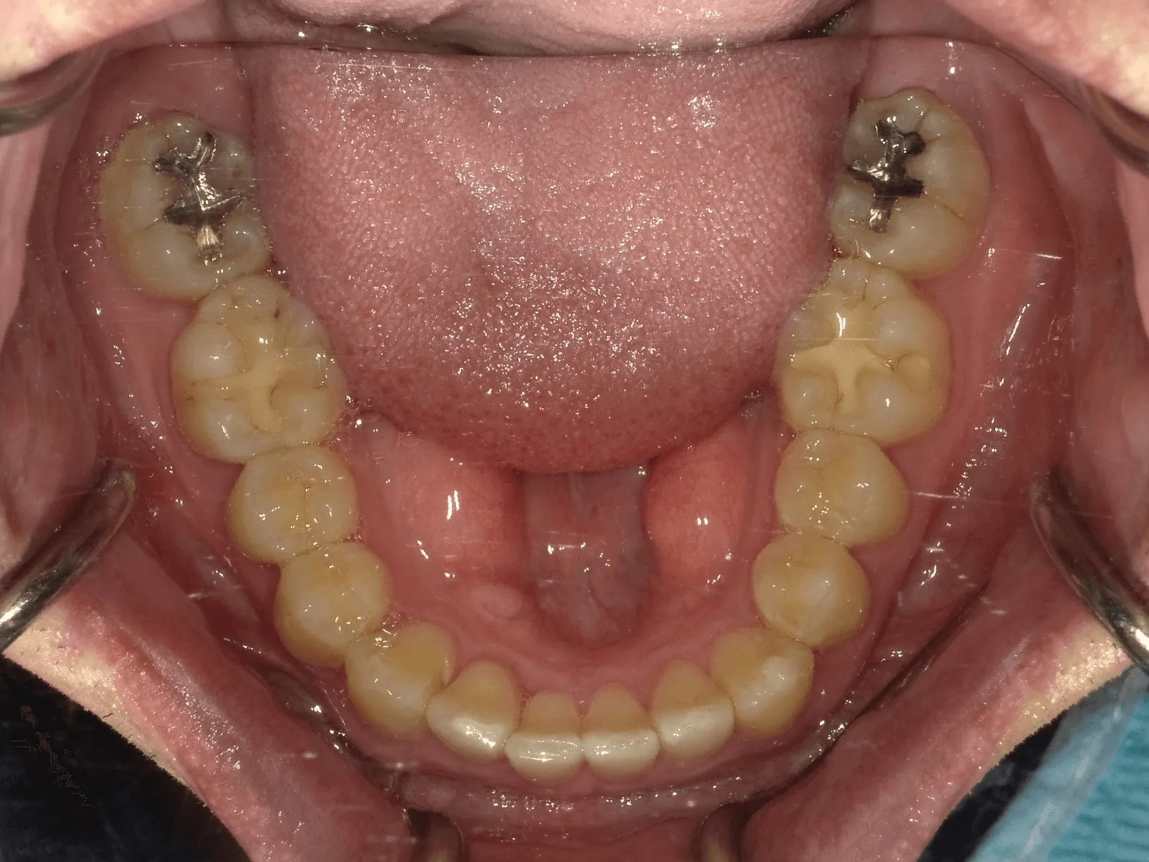 case19