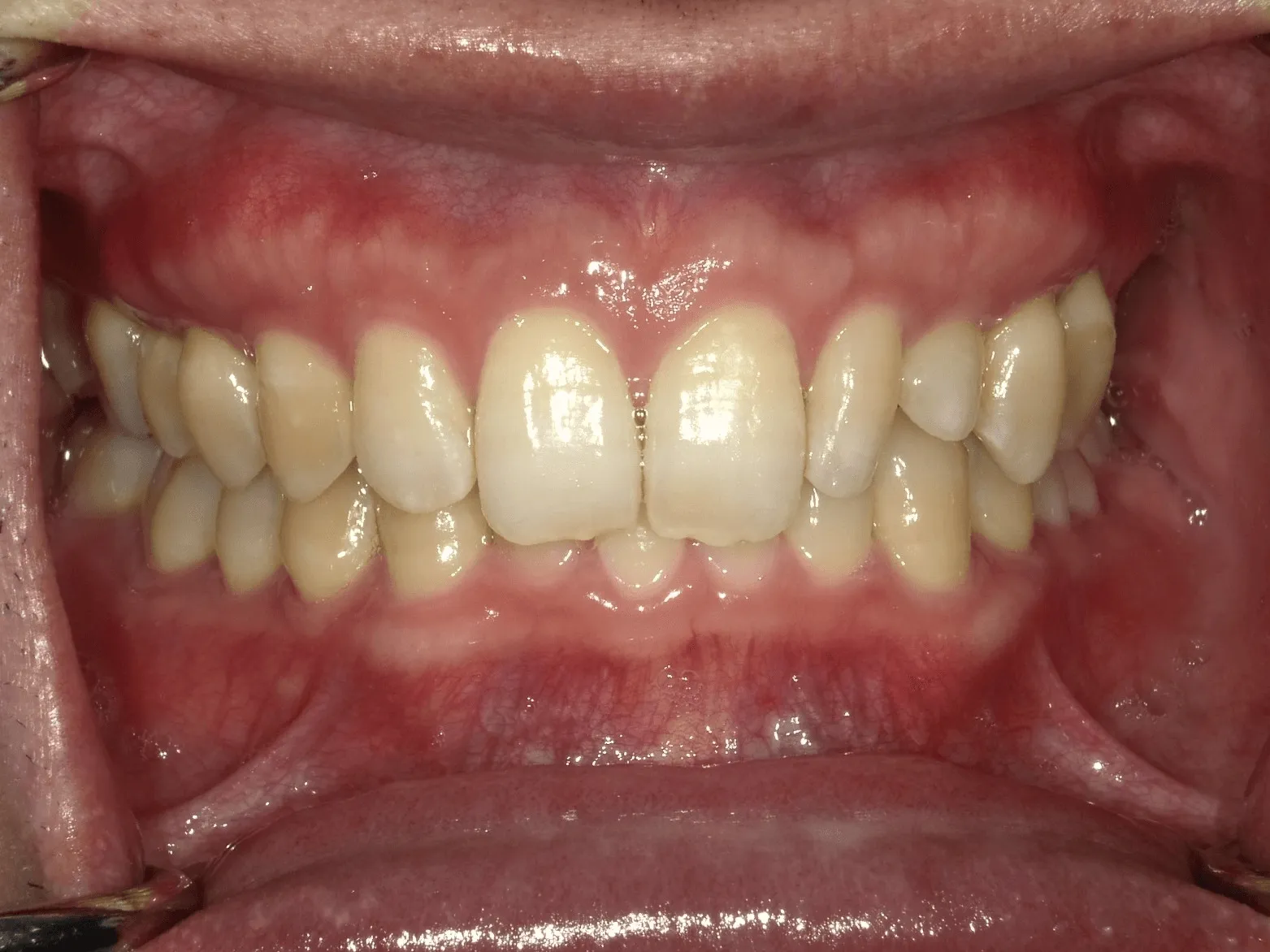 CASE19