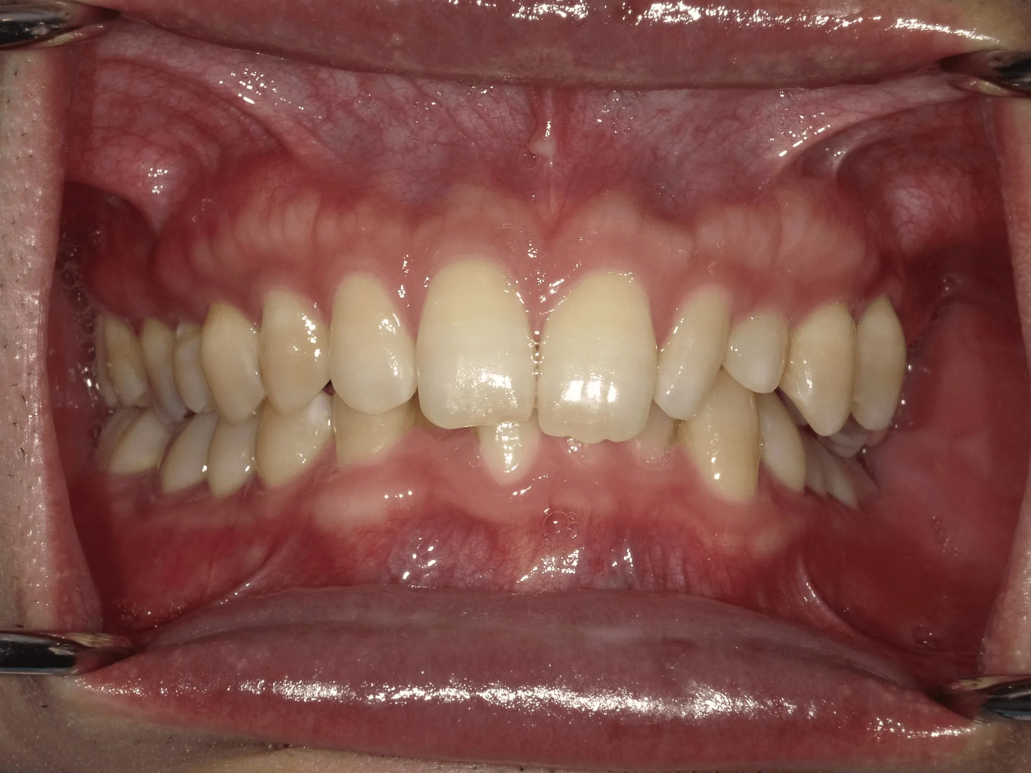 CASE19