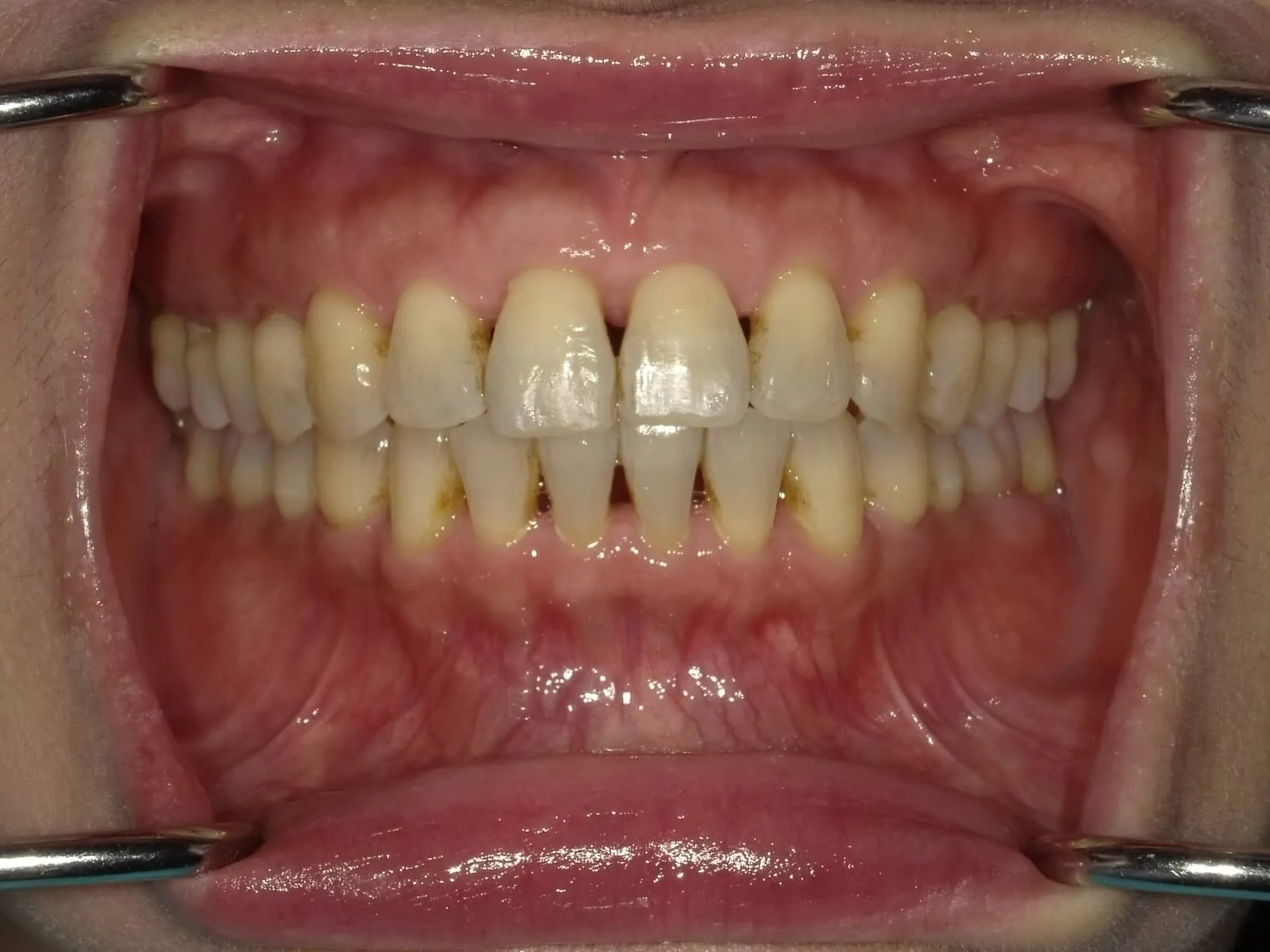 CASE20