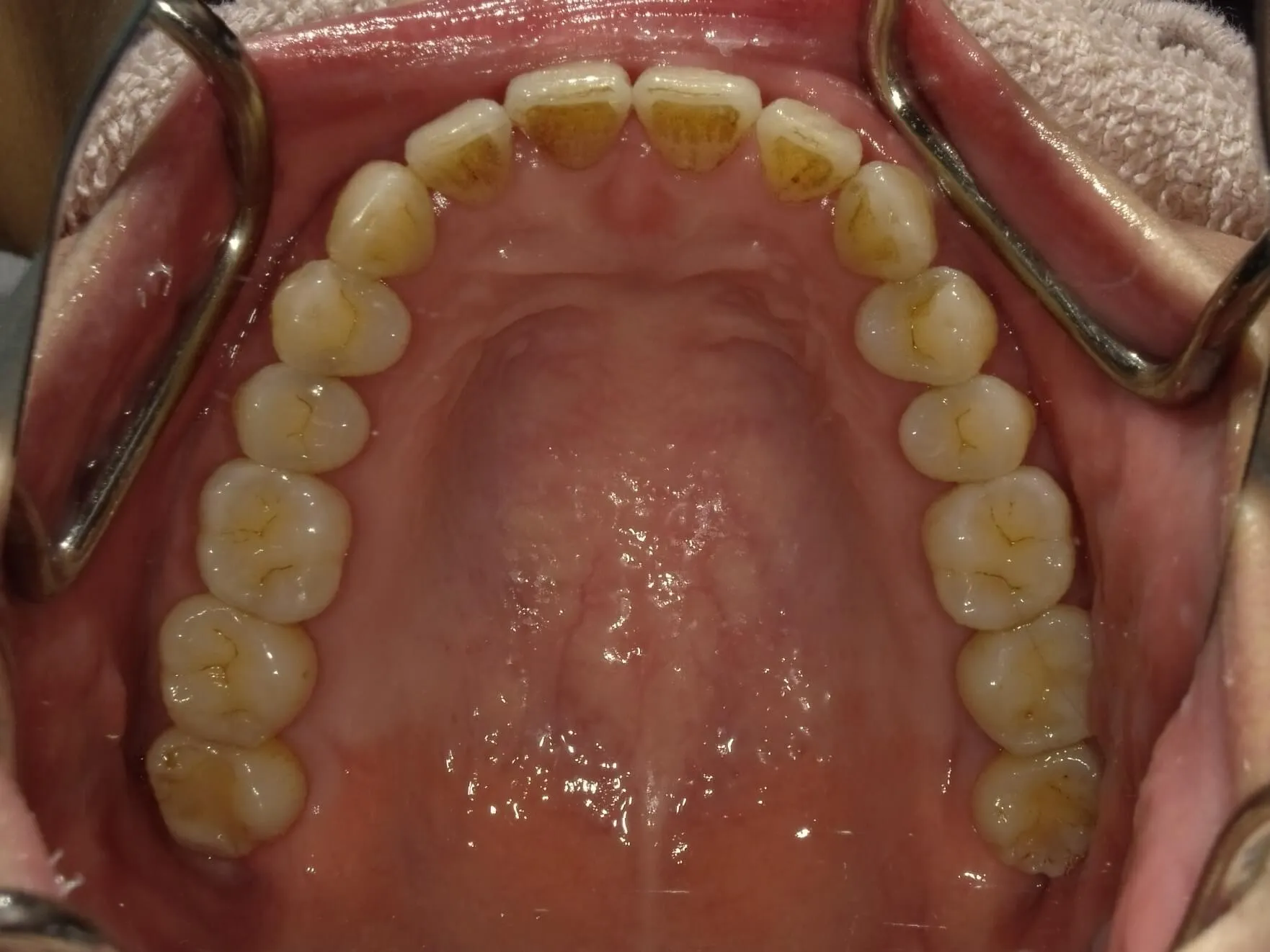 CASE20