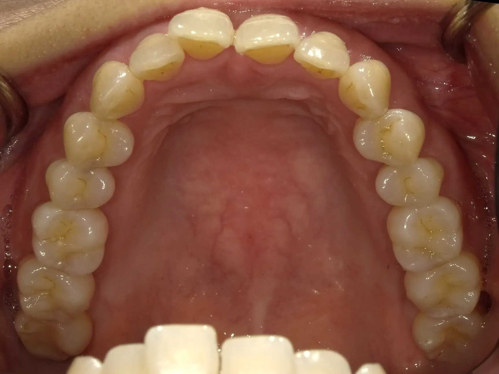 CASE20