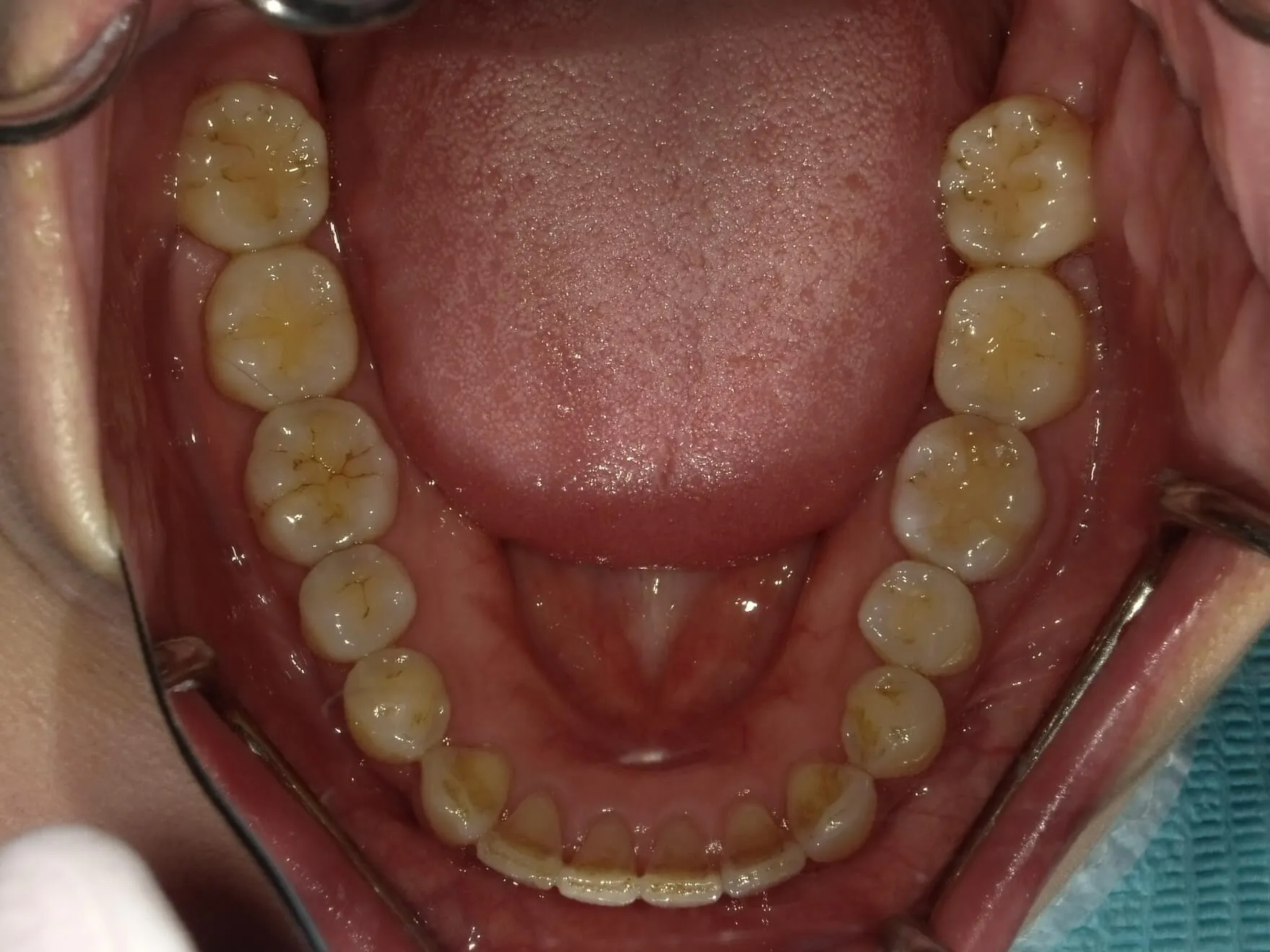 CASE20