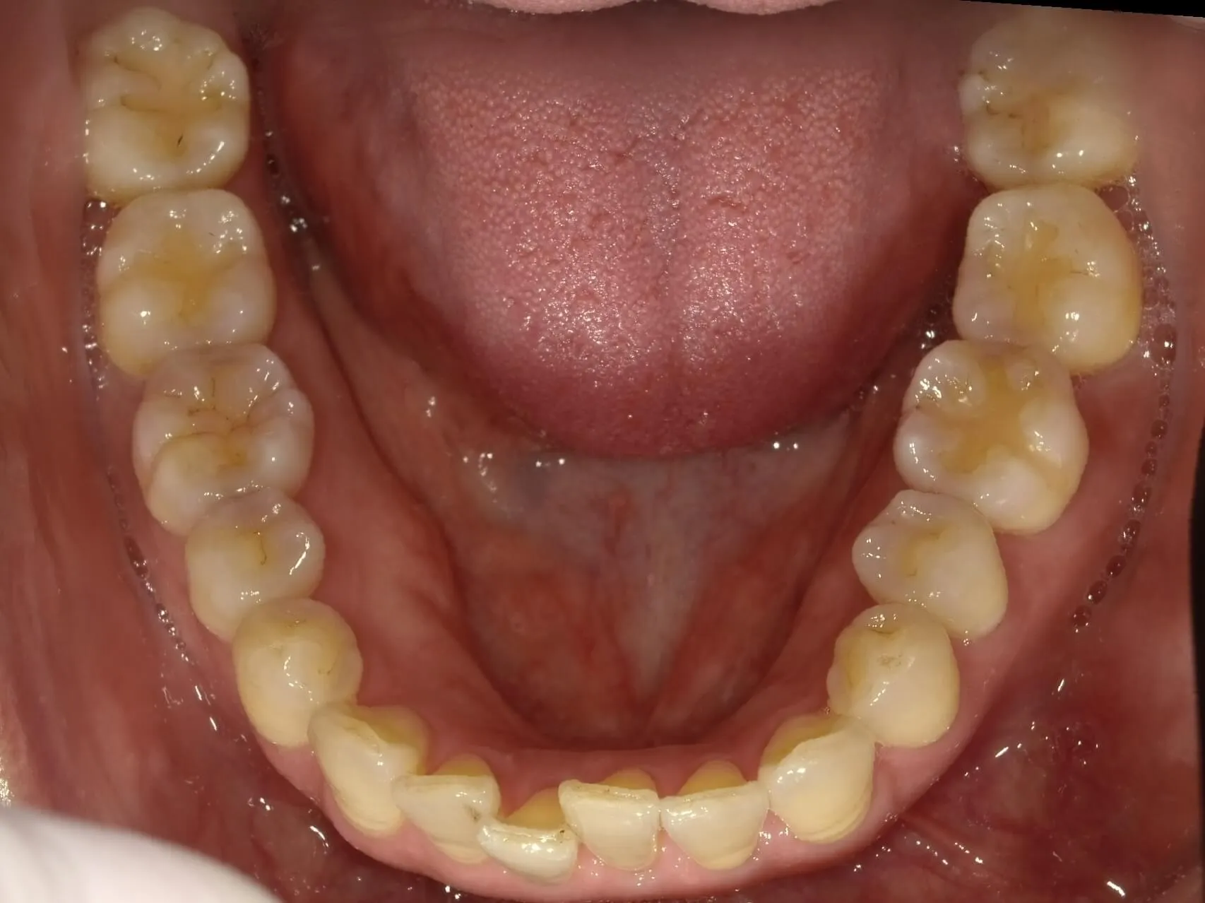 CASE20