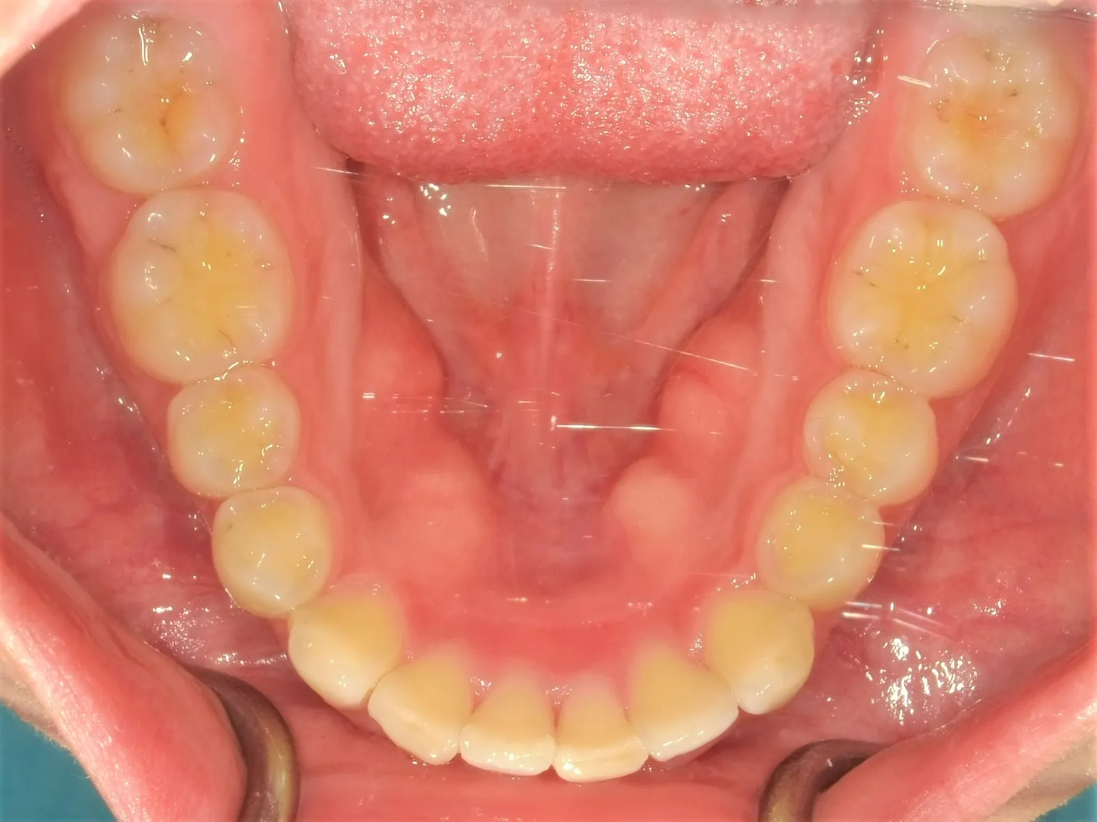 CASE21
