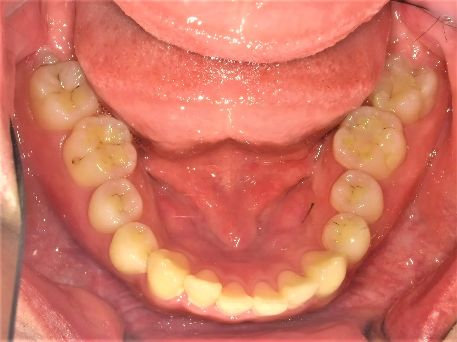 CASE19