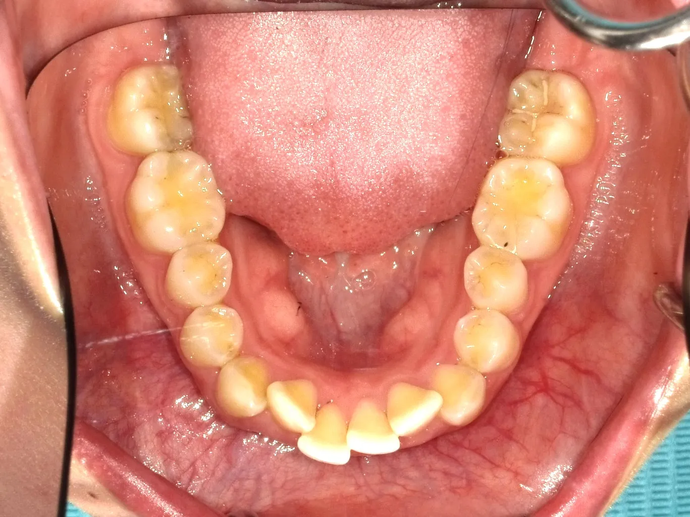 case14