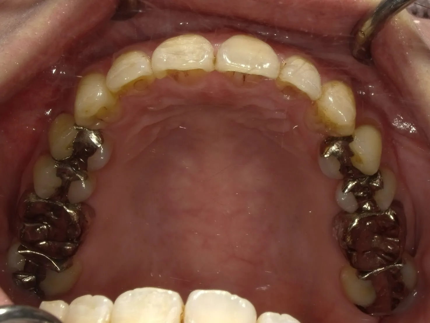 CASE12
