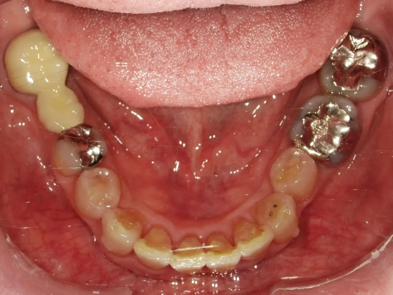 CASE13