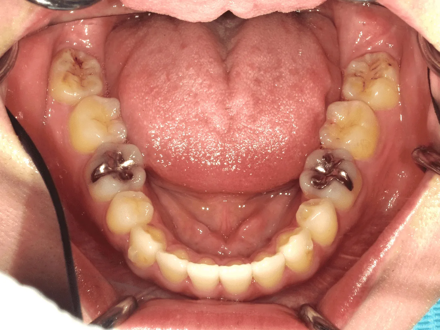 case16