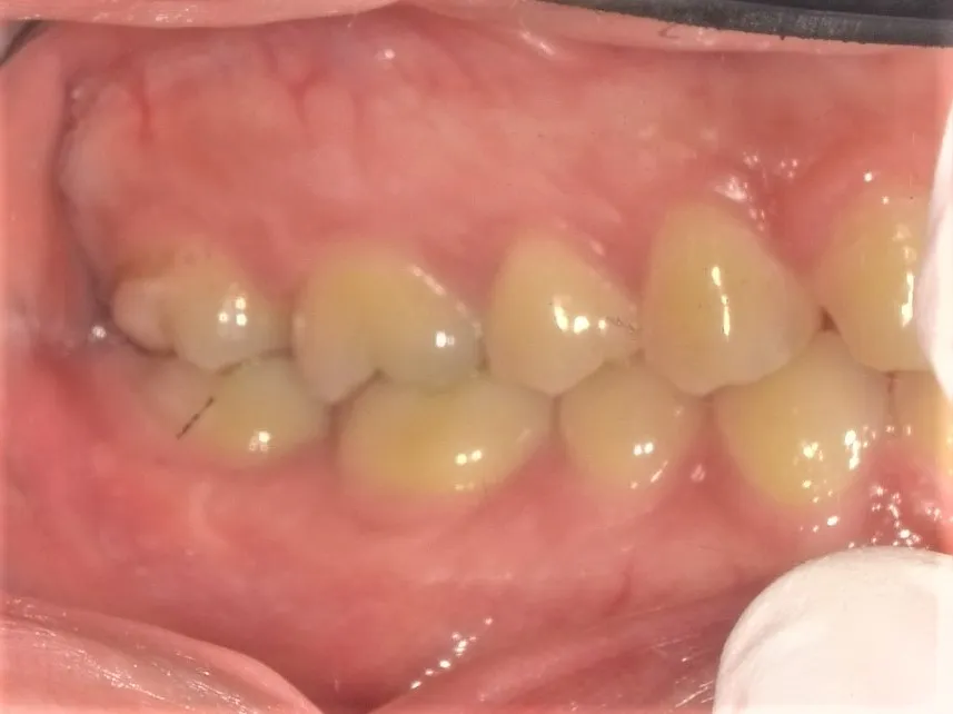CASE21
