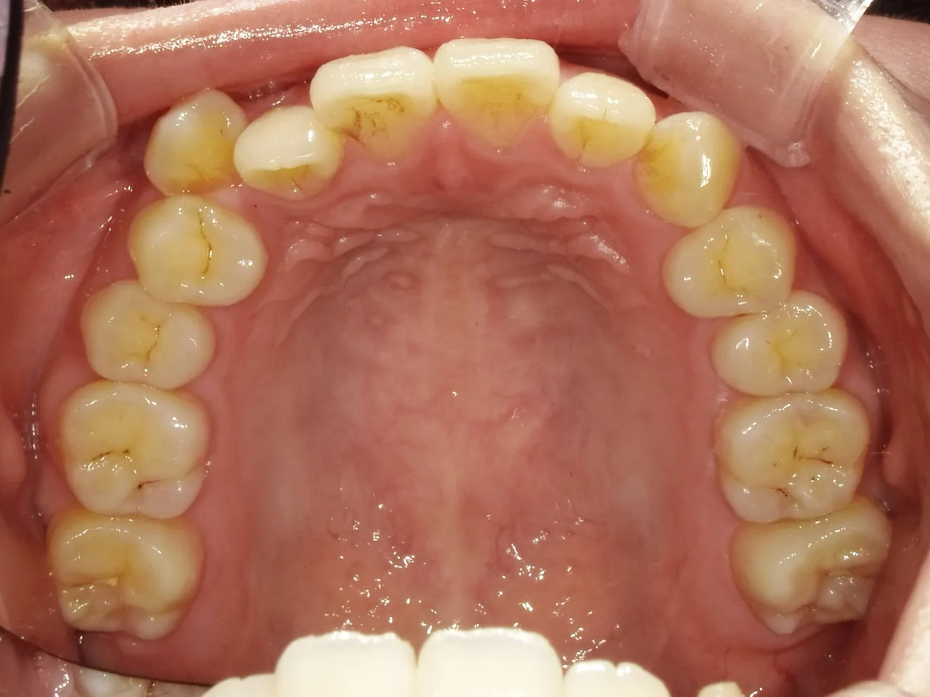 CASE13