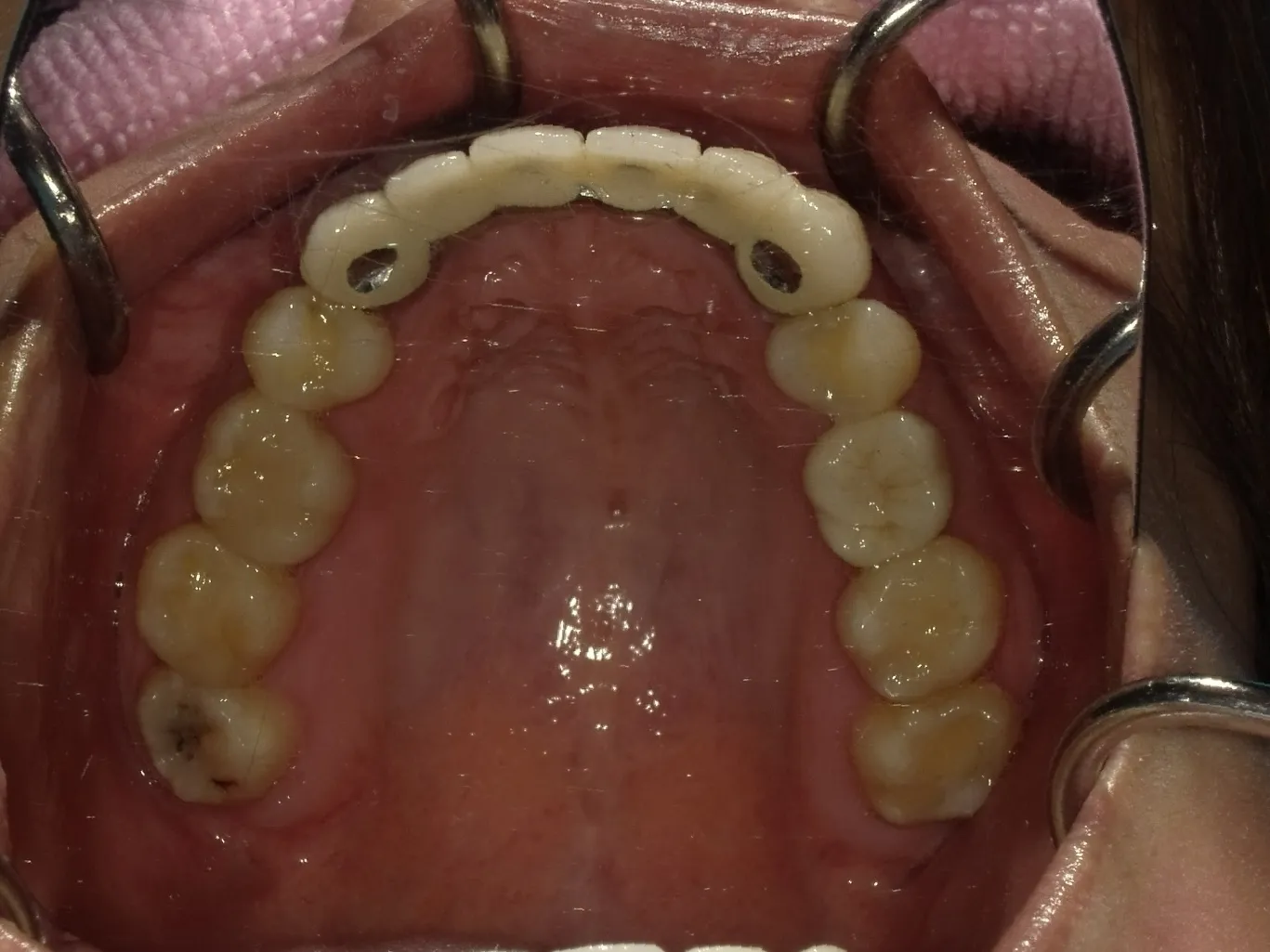 CASE18