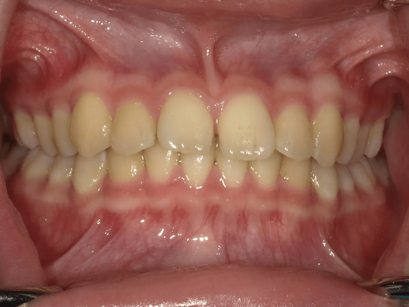CASE12