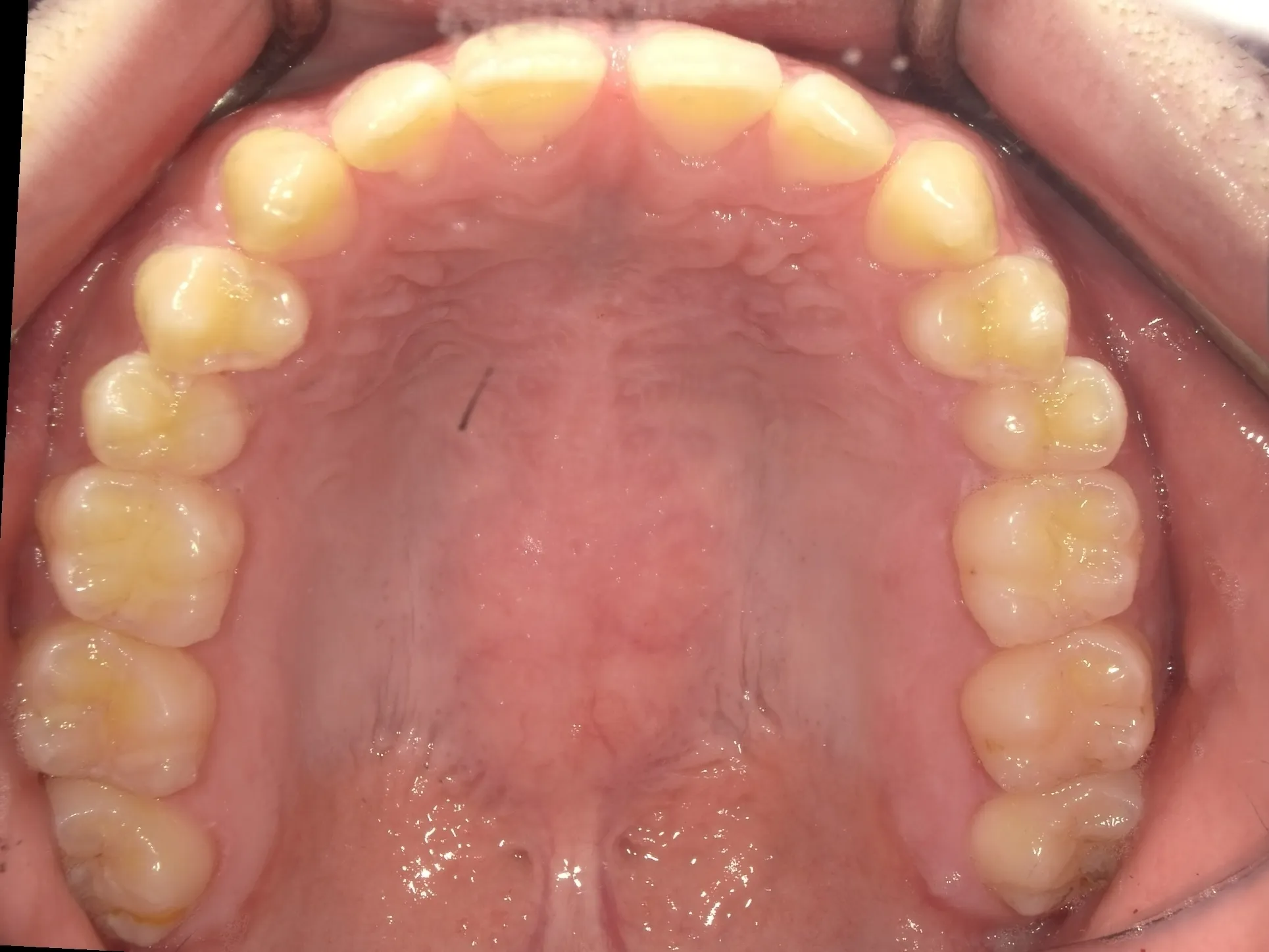 CASE13